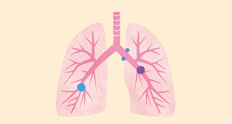 小細胞肺がんについてイメージ
