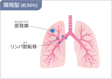 図：限局型（約30％）