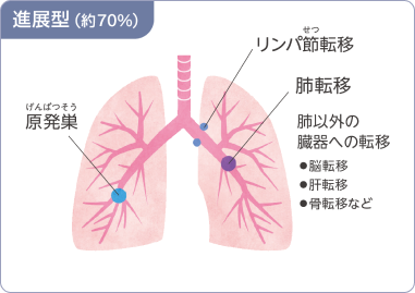 図：進展型（約70％）